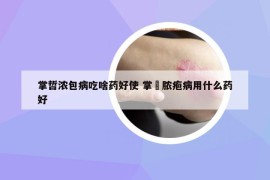 掌哲濃包病吃啥藥好使 掌踀膿皰病用什么藥好