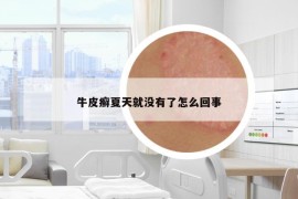 牛皮癬夏天就沒有了怎么回事