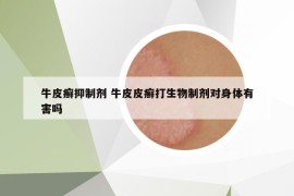 牛皮癬抑制劑 牛皮皮癬打生物制劑對身體有害嗎