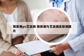 銀屑病yu艾滋病 銀屑病與艾滋病皮膚病圖片