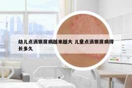 幼兒點(diǎn)滴銀屑病越來(lái)越大 兒童點(diǎn)滴銀屑病得長(zhǎng)多久