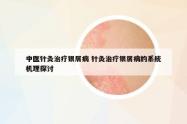 中醫(yī)針灸治療銀屑病 針灸治療銀屑病的系統(tǒng)機理探討
