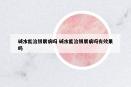 堿水能治銀屑病嗎 堿水能治銀屑病嗎有效果嗎