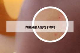 白癜風(fēng)病人能吃干棗嗎