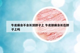 牛皮癬會不會長到脖子上 牛皮膚癬會長在脖子上嗎