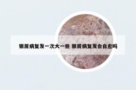 銀屑病復(fù)發(fā)一次大一些 銀屑病復(fù)發(fā)會(huì)自愈嗎