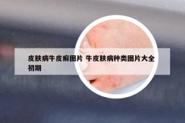 皮膚病牛皮癬圖片 牛皮膚病種類圖片大全 初期