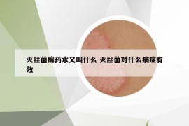 滅絲菌癬藥水又叫什么 滅絲菌對(duì)什么病癥有效