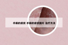 手癬的癥狀 手癬的癥狀圖片 治療方法