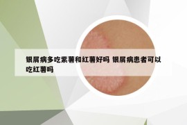 銀屑病多吃紫薯和紅薯好嗎 銀屑病患者可以吃紅薯嗎