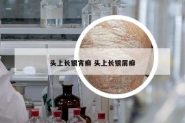頭上長銀宵癬 頭上長銀屑癬