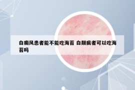 白癜風(fēng)患者能不能吃海苔 白顛瘋者可以吃海苔嗎