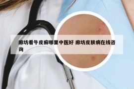 廊坊看牛皮癬哪里中醫(yī)好 廊坊皮膚病在線咨詢