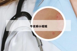 牛皮癬小姐姐
