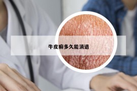 牛皮癬多久能消退