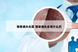 銀屑病大頭菜 銀屑病頭皮用什么藥