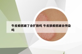 牛皮癬抓破了會擴散嗎 牛皮膚癬抓破會傳染嗎