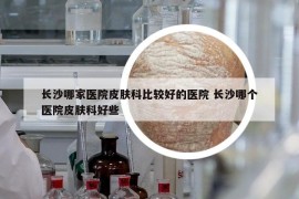 長沙哪家醫(yī)院皮膚科比較好的醫(yī)院 長沙哪個醫(yī)院皮膚科好些