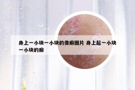 身上一小塊一小塊的像癬圖片 身上起一小塊一小塊的癬
