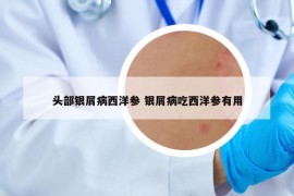 頭部銀屑病西洋參 銀屑病吃西洋參有用