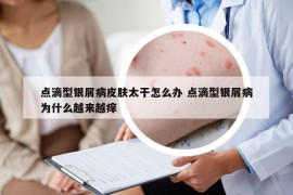 點(diǎn)滴型銀屑病皮膚太干怎么辦 點(diǎn)滴型銀屑病為什么越來越癢