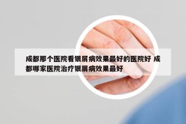 成都那個(gè)醫(yī)院看銀屑病效果最好的醫(yī)院好 成都哪家醫(yī)院治療銀屑病效果最好