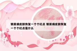 銀屑病皮膚恢復(fù)一個個紅點 銀屑病皮膚恢復(fù)一個個紅點是什么