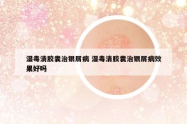 濕毒清膠囊治銀屑病 濕毒清膠囊治銀屑病效果好嗎