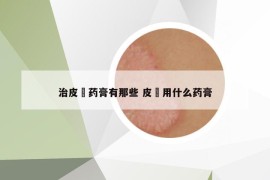 治皮廯藥膏有那些 皮廯用什么藥膏