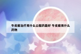 牛皮廨治療用什么口服藥最好 牛皮廨用什么藥物