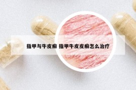 指甲與牛皮癬 指甲牛皮皮癬怎么治療
