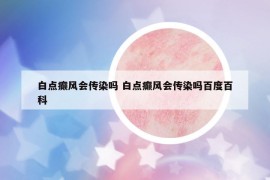 白點(diǎn)癲風(fēng)會(huì)傳染嗎 白點(diǎn)癲風(fēng)會(huì)傳染嗎百度百科