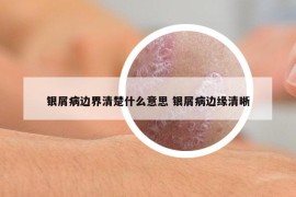 銀屑病邊界清楚什么意思 銀屑病邊緣清晰