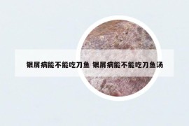 銀屑病能不能吃刀魚 銀屑病能不能吃刀魚湯