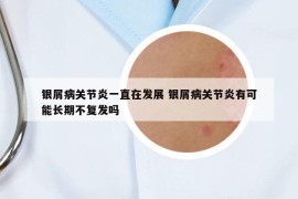 銀屑病關節(jié)炎一直在發(fā)展 銀屑病關節(jié)炎有可能長期不復發(fā)嗎