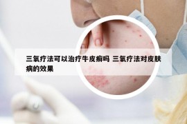 三氧療法可以治療牛皮癬嗎 三氧療法對皮膚病的效果