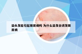 染頭發(fā)能引起銀屑病嗎 為什么染發(fā)會誘發(fā)銀屑病