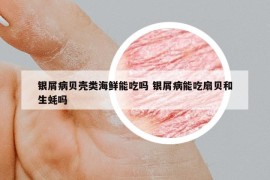 銀屑病貝殼類海鮮能吃嗎 銀屑病能吃扇貝和生蠔嗎