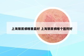 上海銀屑病哪里最好 上海銀屑病哪個(gè)醫(yī)院好