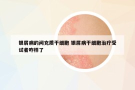 銀屑病的間充質(zhì)干細(xì)胞 銀屑病干細(xì)胞治療受試者咋樣了