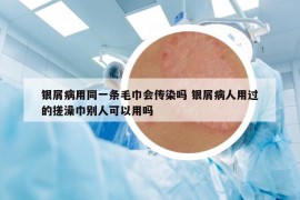 銀屑病用同一條毛巾會傳染嗎 銀屑病人用過的搓澡巾別人可以用嗎