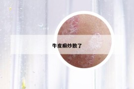 牛皮癬炒散了