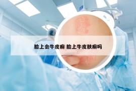臉上會(huì)牛皮癬 臉上牛皮膚癬嗎