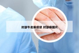 肘部牛皮癬癥狀 肘部癬圖片