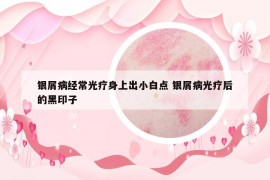 銀屑病經(jīng)常光療身上出小白點 銀屑病光療后的黑印子