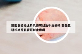 醋酸氧輕松冰片乳膏可以治牛皮癬嗎 醋酸氟輕松冰片乳膏可以止癢嗎