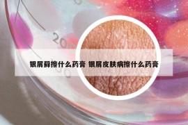 銀屑蘚擦什么藥膏 銀屑皮膚病擦什么藥膏