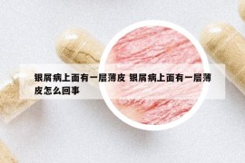 銀屑病上面有一層薄皮 銀屑病上面有一層薄皮怎么回事