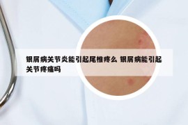 銀屑病關(guān)節(jié)炎能引起尾椎疼么 銀屑病能引起關(guān)節(jié)疼痛嗎