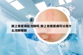 腳上銀屑病能泡腳嗎 腳上有銀屑病可以用什么泡腳緩解